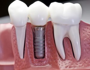 Dental Implants In Rockville