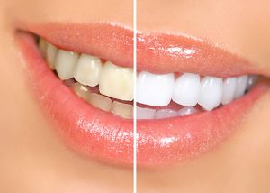 teeth-whitening-toronto